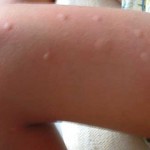 Pierna infantil con picadas de mosquito