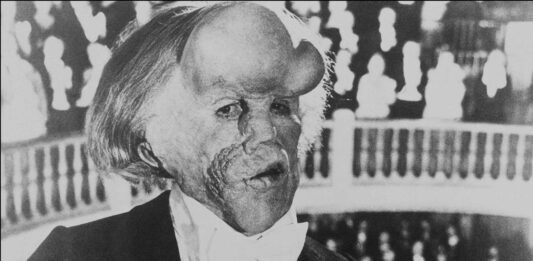 la enfermedad del hombre elefante