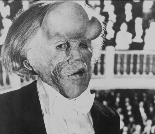 la enfermedad del hombre elefante