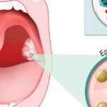 mononucleosis