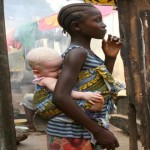 Curiosidades sobre el albinismo