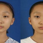 Mujeres asiáticas: ¡Quiero tener los ojos como las occidentales!