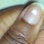 leuconiquia parcial
