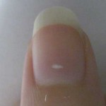 leucoquinia