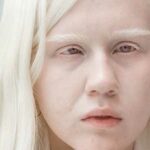 personas albinas
