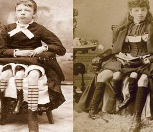 Myrtle Corbin, la chica con cuatro piernas de Texas