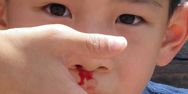 sangrado nasal niño