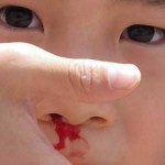 sangrado nasal niño