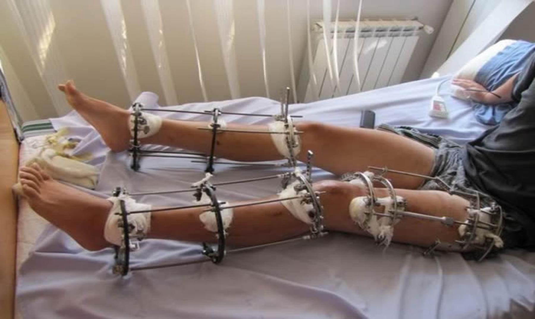 Cirugía estética: "Romperse" las piernas para ser más altos