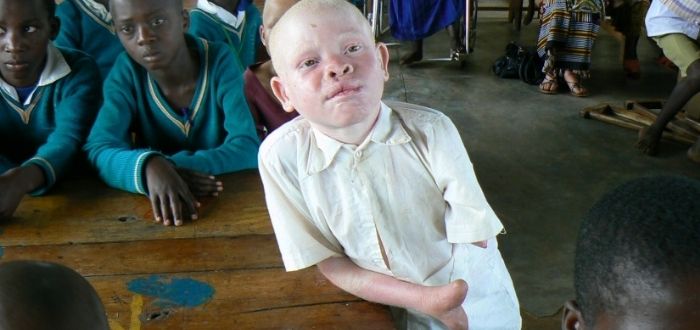 albinos en África