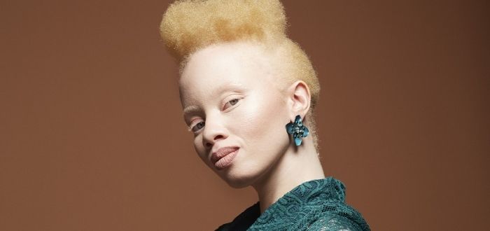 albinos en África