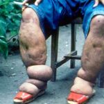 elefantiasis deformacion