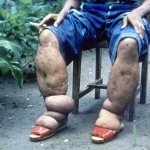 La rara afección de la elefantiasis