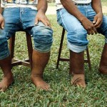 Hermanos con elefantiasis (Filipinas, 1985)