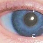 Síndrome de Alejandría, ¿la enfermedad de los ojos violetas?