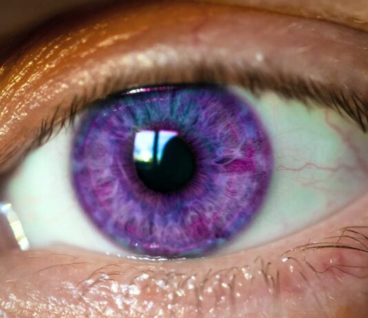 que es el sindrome de alejandria ojos de color morado