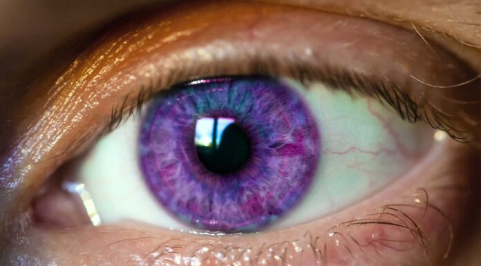 que es el sindrome de alejandria ojos de color morado