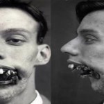 Las 3 primeras e impactantes operaciones de cirugía estética