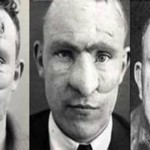 Las 3 primeras e impactantes operaciones de cirugía estética