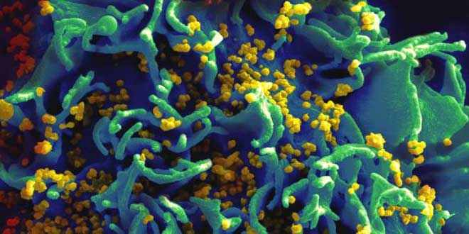 Célula T-H9 infectada por VIH