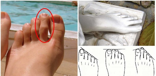 dedo de morton, pie griego