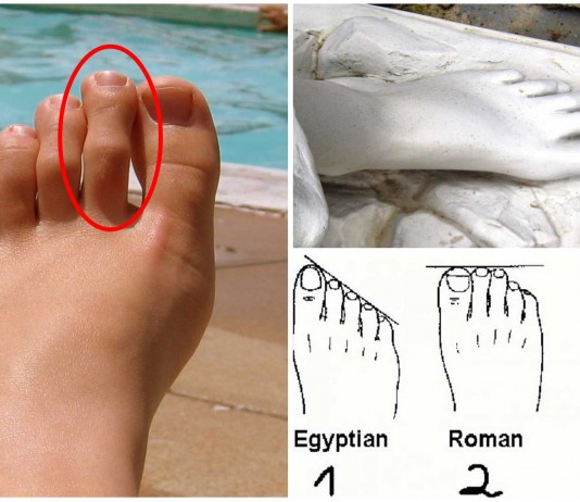 dedo de morton, pie griego