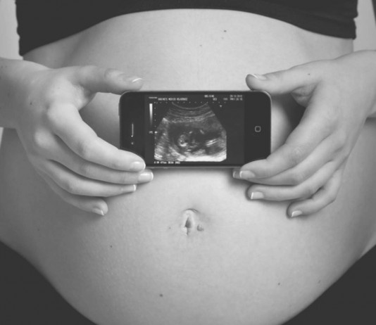 ¿Se puede quedar una mujer embarazada estando ya embarazada? superfetación, ¿Se puede quedar una mujer embarazada estando ya embarazada?