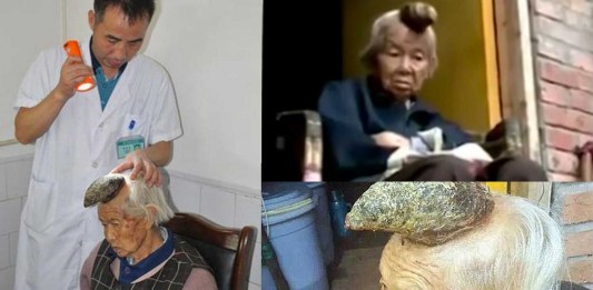 El caso de la “mujer unicornio”. Médicos muy sorprendidos El caso de la “mujer unicorno”. Médicos muy sorprendidos