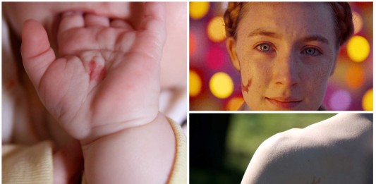 Y tú... ¿Tienes marcas de nacimiento? ¿A qué pueden deberse?