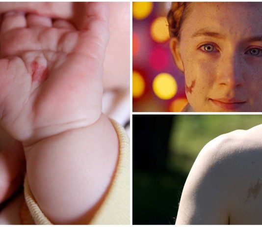 Y tú… ¿Tienes marcas de nacimiento? ¿A qué pueden deberse? Y tú... ¿Tienes marcas de nacimiento? ¿A qué pueden deberse?