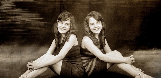 La triste historia de las hermanas siamesas "encadenadas" por la espalda