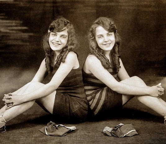 La triste historia de las hermanas siamesas "encadenadas" por la espalda