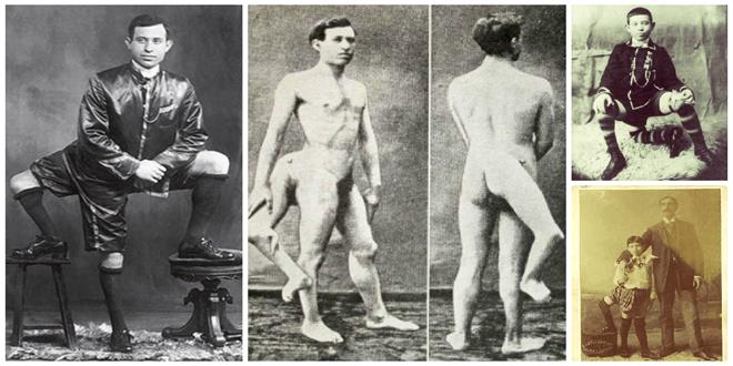 Francesco Lentini, el hombre con tres piernas... Y dos genitales