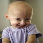 Progeria, la triste enfermedad que convierte a los niños en ancianos