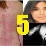 Famosos que padecen psoriasis