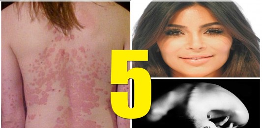 famosos con psoriasis, famosos que padecen psoriasis