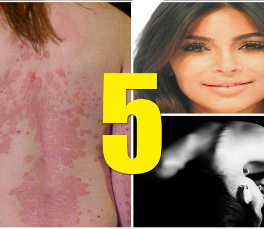 famosos con psoriasis, famosos que padecen psoriasis