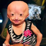 Adalia Ross, niña con progeria
