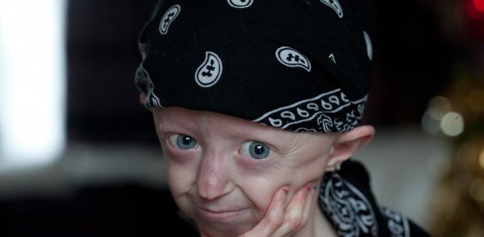 Progeria, la triste enfermedad que convierte a los niños en ancianos