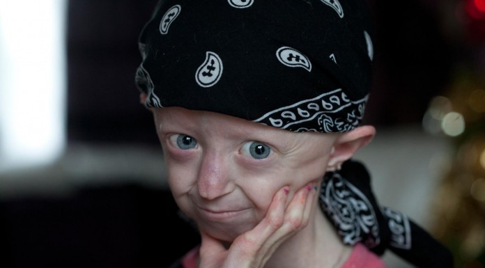 Progeria, la triste enfermedad que convierte a los niños en ancianos
