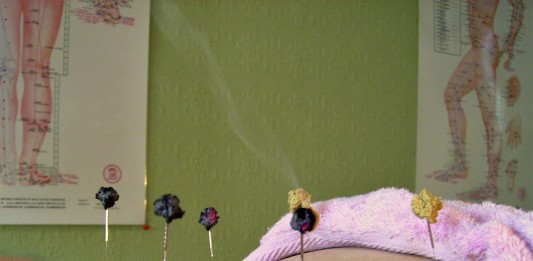 Qué es la acupuntura. ¡Te lo explicamos!