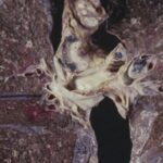 Tuberculosis