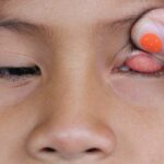 Tracoma