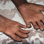 Las 7 enfermedades más antiguas conocidas