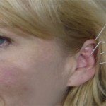 agujas en oreja