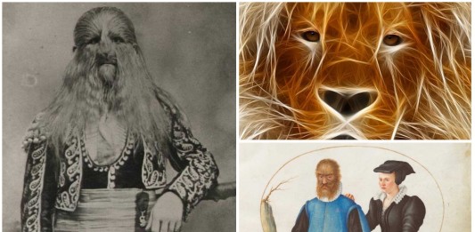 La historia de Lionel, un niño con rostro de león