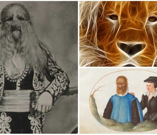 La historia de Lionel, un niño con rostro de león