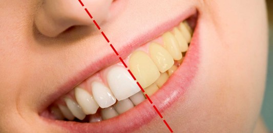 Dientes amarillos, ¿por qué?