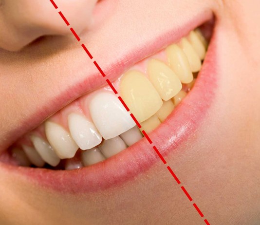 Dientes amarillos, ¿por qué? Dientes amarillos, ¿por qué?