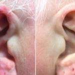 El misterioso síndrome de «la oreja roja»